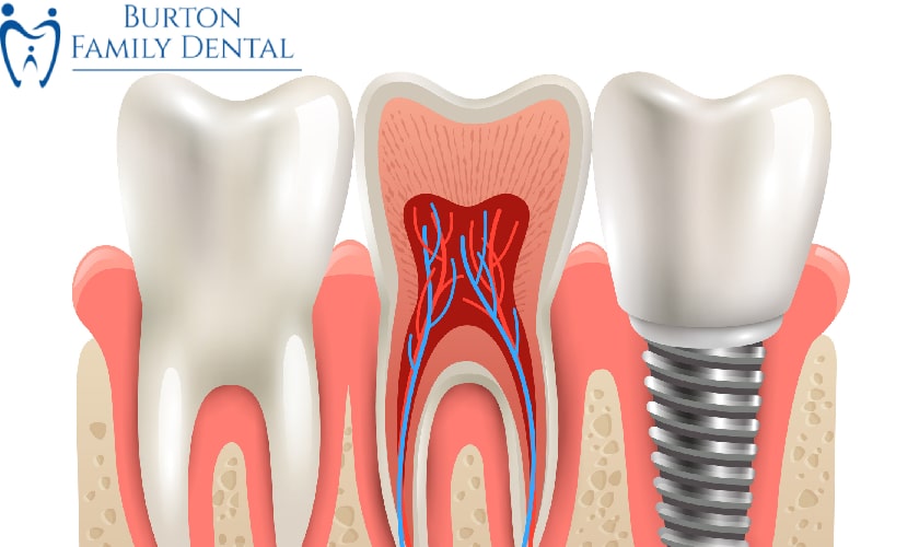 Burton Family Dental - Dental Implants