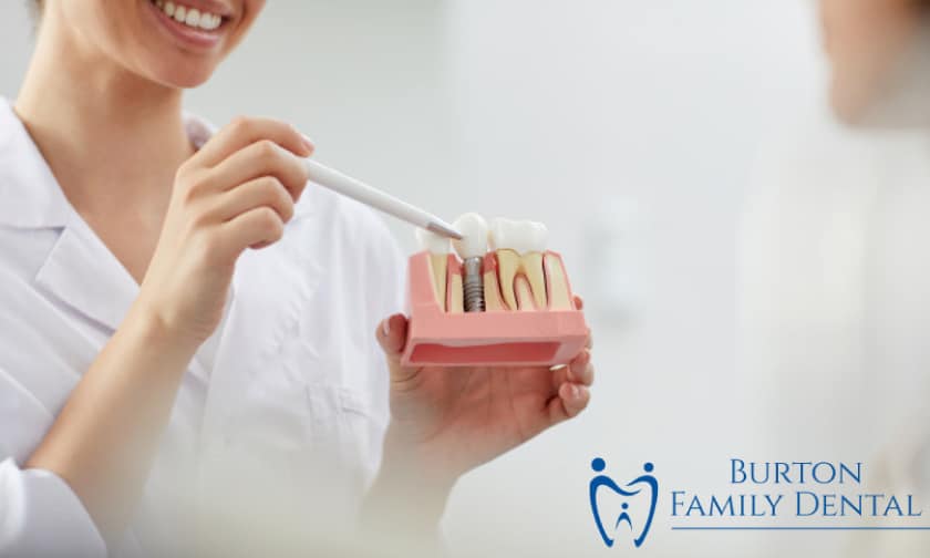 Burton Family Dental - Dental Implants