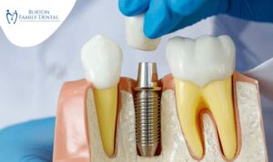 Reasons-why-dental-implants-are-better-than-dentures