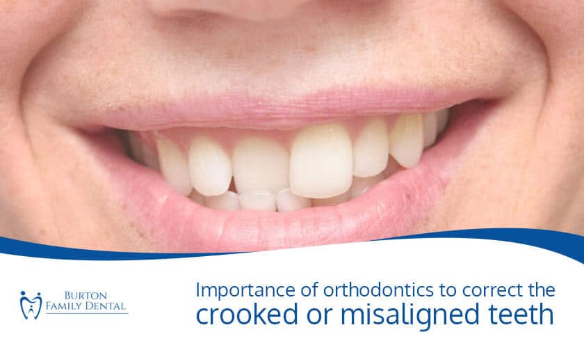 Importance of orthodontics to correct the crooked or misaligned teeth