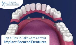Top 4 Tips To Take Care Of Your Implant Secured Dentures
