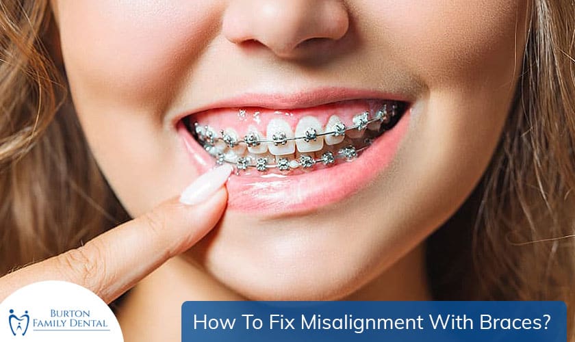 How To Fix Misalignment With Braces