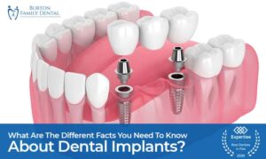 What Are The Different Facts You Need To Know About Dental Implants