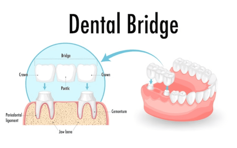 Dental Bridges - Burton Family Dental, MI