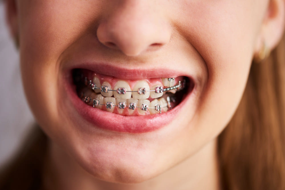 Orthodontic Treatment - Burton Family Dental, MI