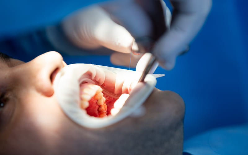 Tooth Extraction - Burton Family Dental, MI