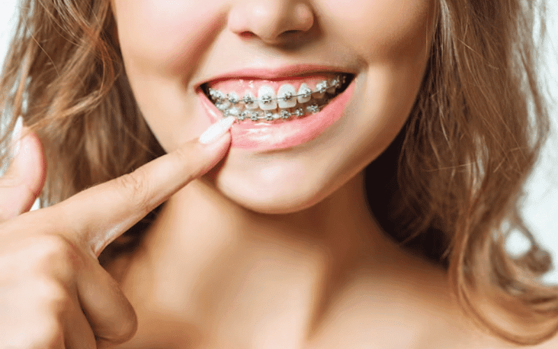 Orthodontic Dentistry - Burton Family Dental
