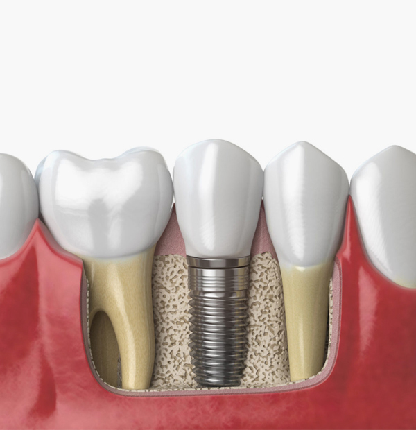 cost of dental implants burton
