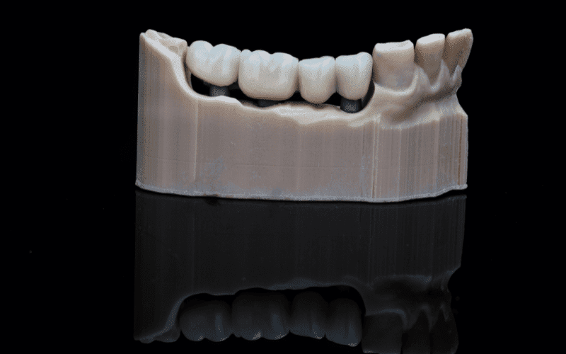 dental bridge