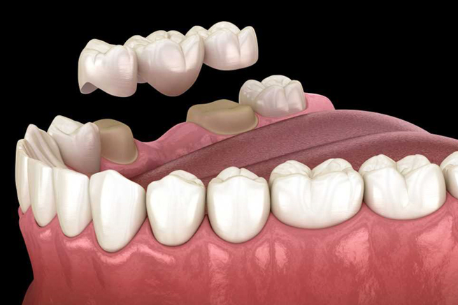 dental bridges burton