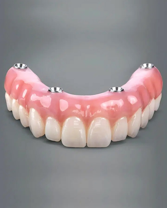 full mouth implant burton