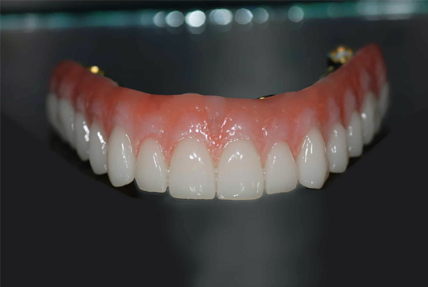 hybrid implant dentures