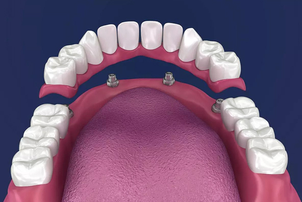 implant retained dentures burton