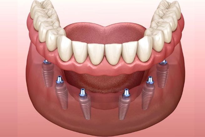 implant secured dentures burton