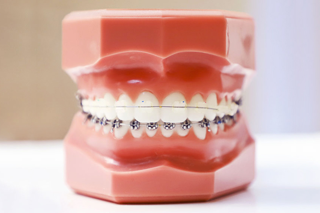 orthodontics treatment burton