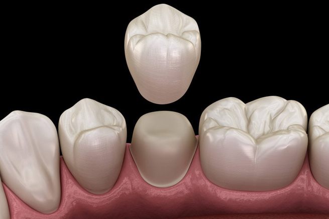 same day crowns burton