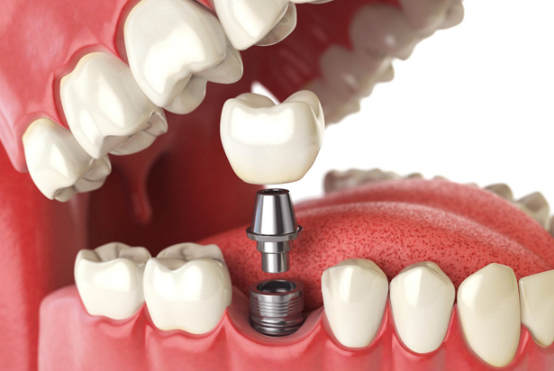 single dental implant burton