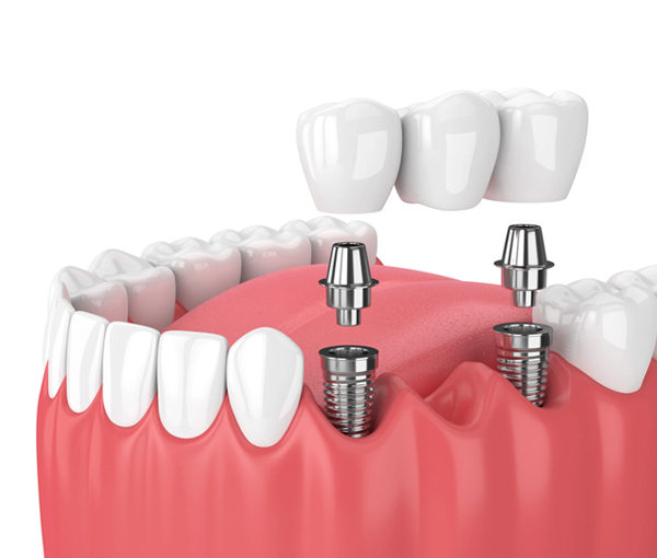 single tooth implants and bridges burton
