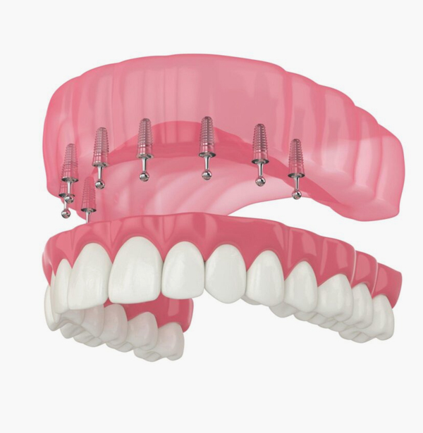 snap in implant dentures burton