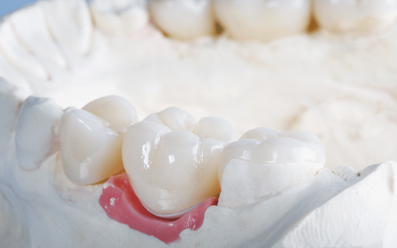 Dental Crowns