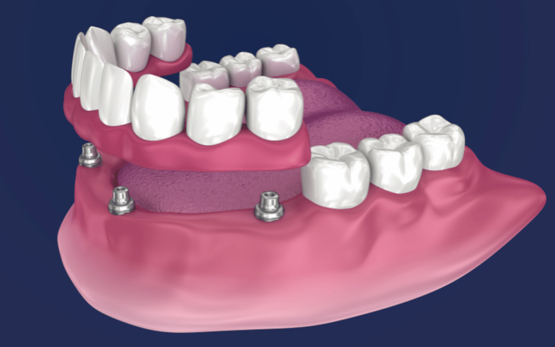 snap-on dentures