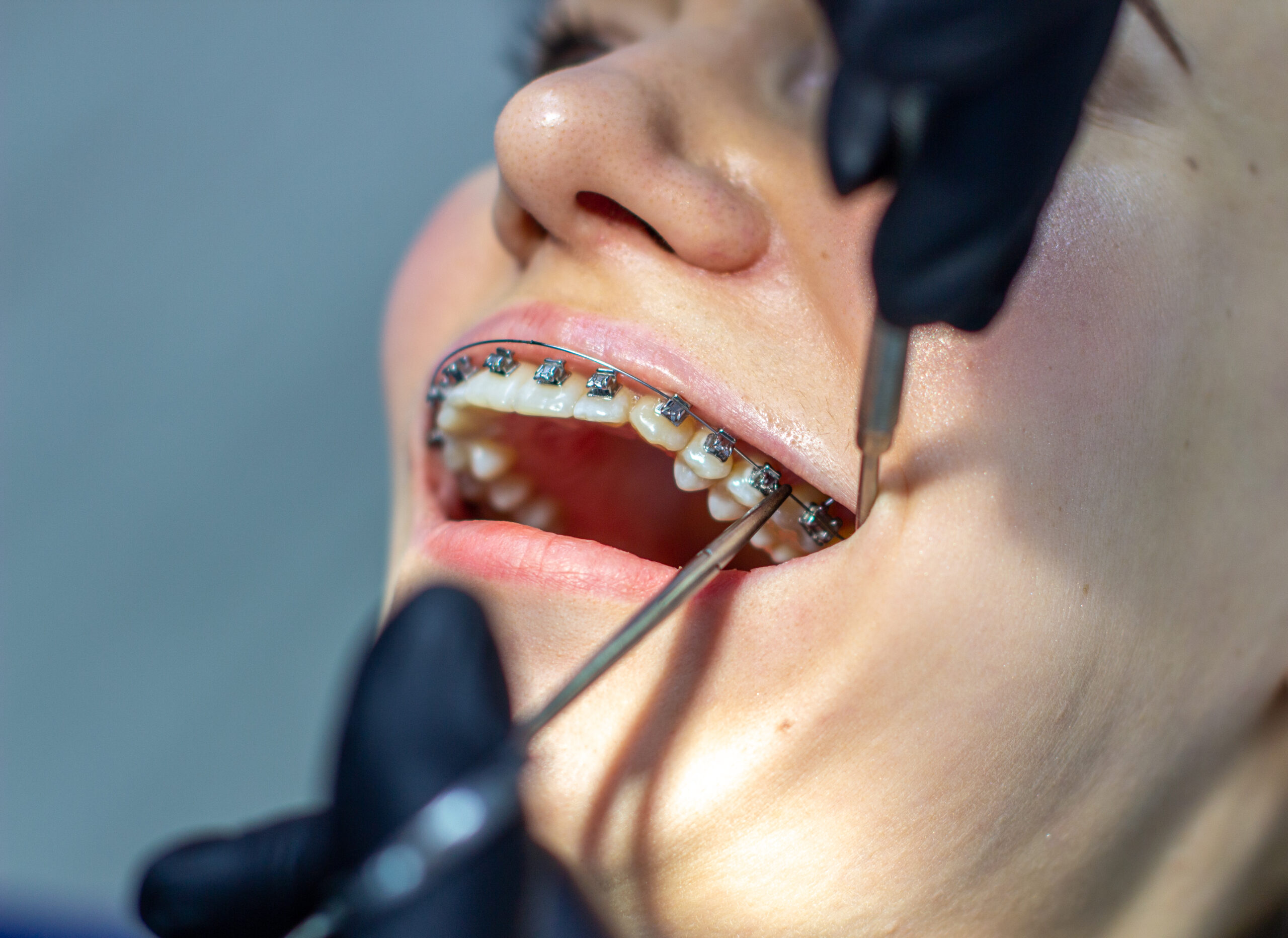 Braces in Burton